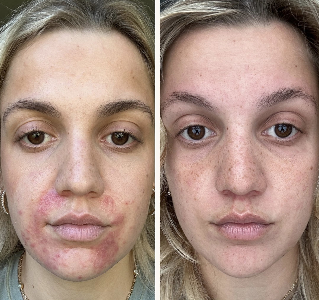 Struggling With Perioral Dermatitis? Start Here.